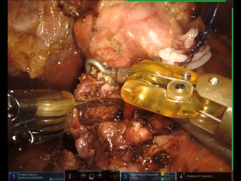 Whipple Robotic Surgery with Xi